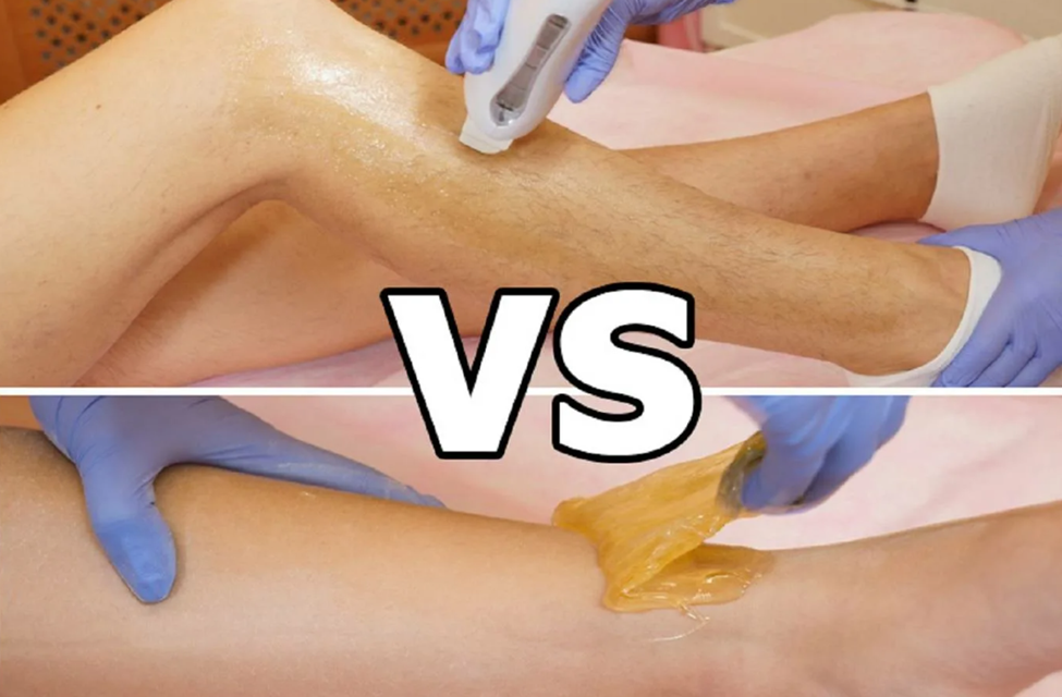 Sugaring and Laser Hair Removal: Pros and Cons - Sugaring Factory Blog